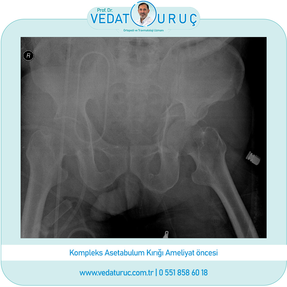 kompleks-asetablum-kirigi-1