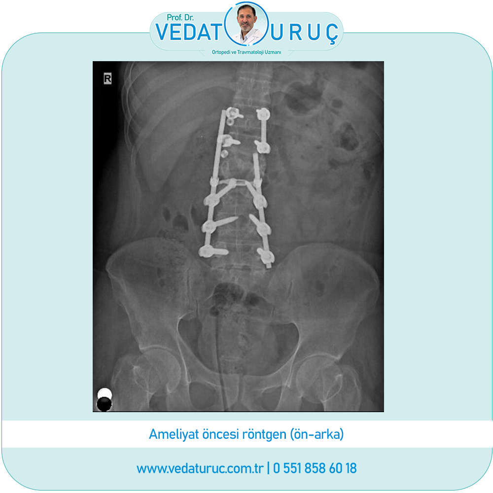 postravmatik-kifoz-implant-yetmezliği-1