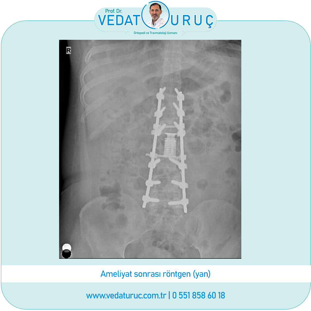 postravmatik-kifoz-implant-yetmezliği-2