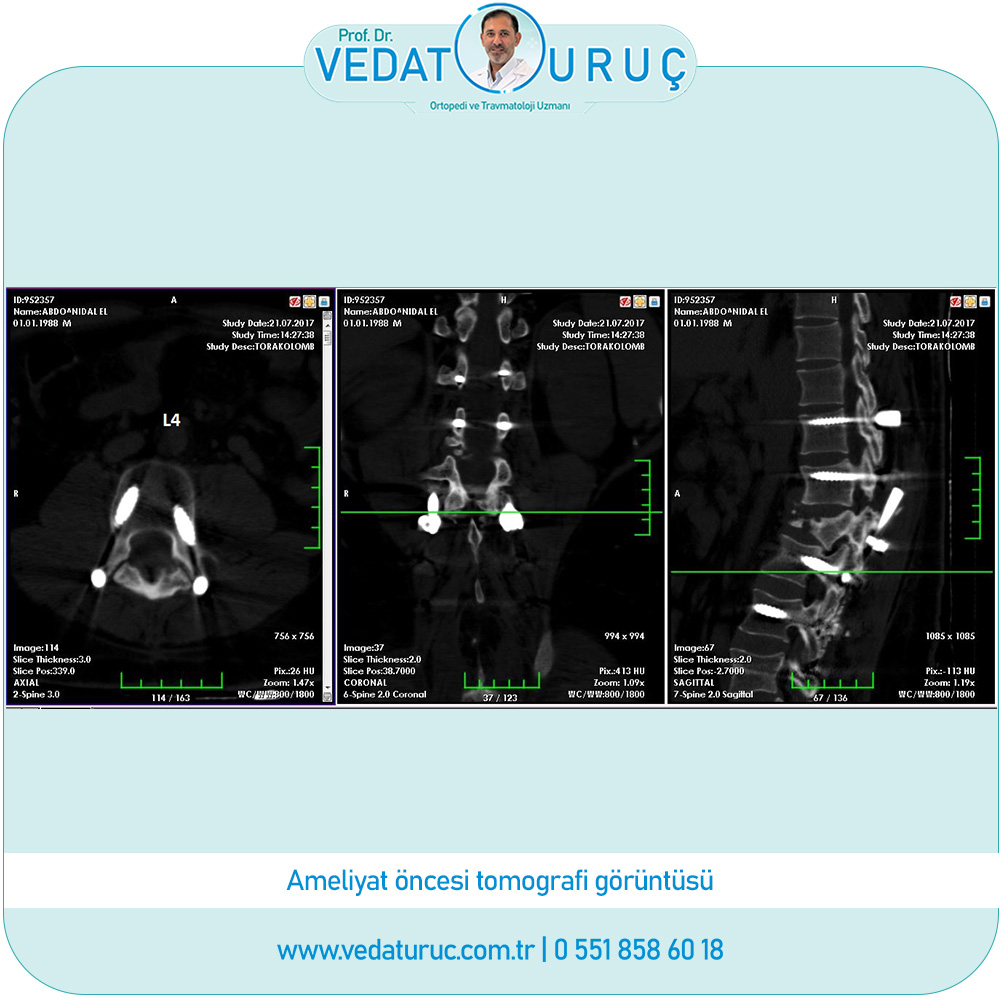 postravmatik-kifoz-implant-yetmezliği-ana